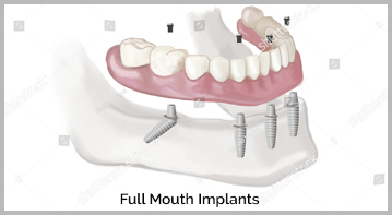 Full Mouth Implants