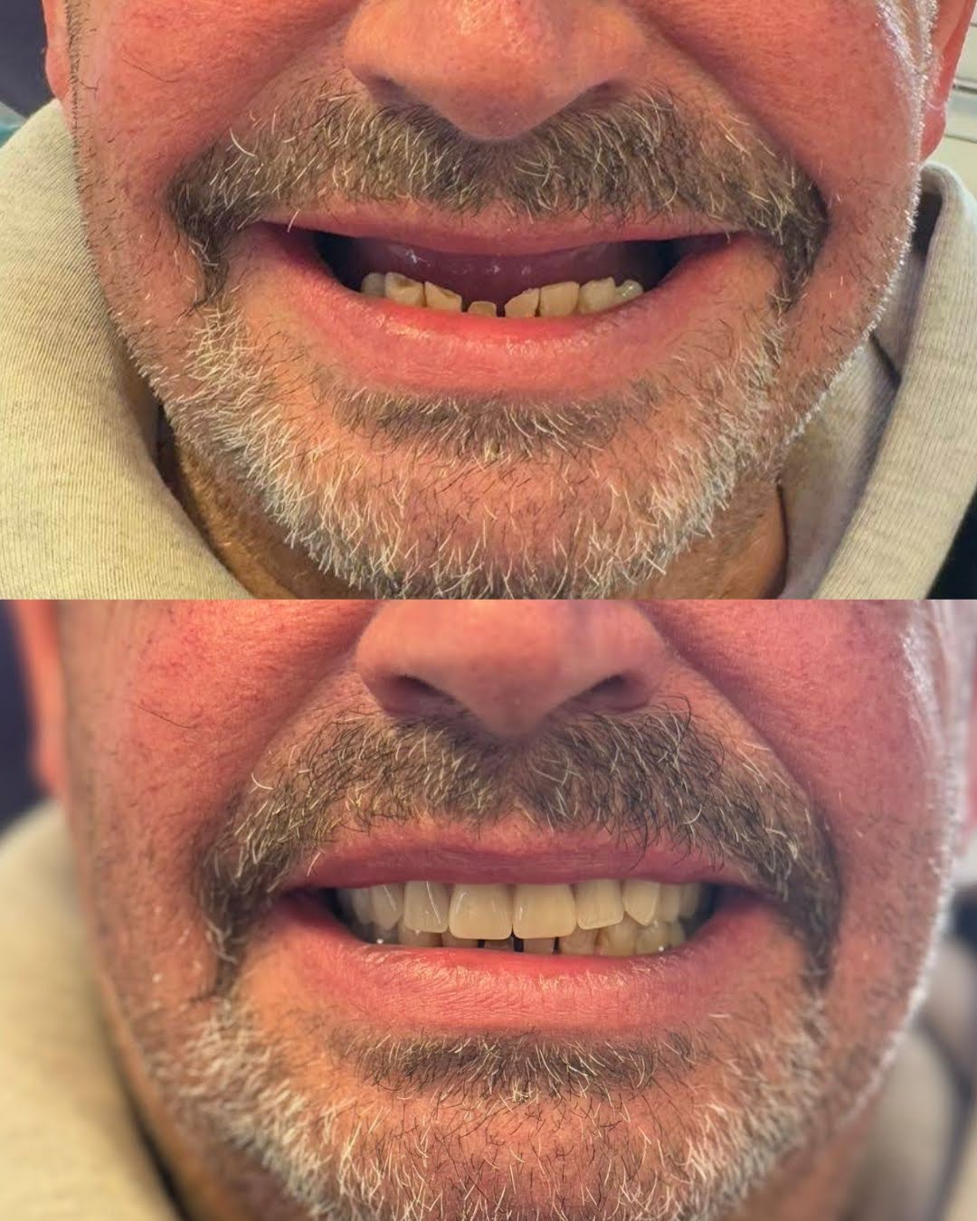 Dental implants before and after 1