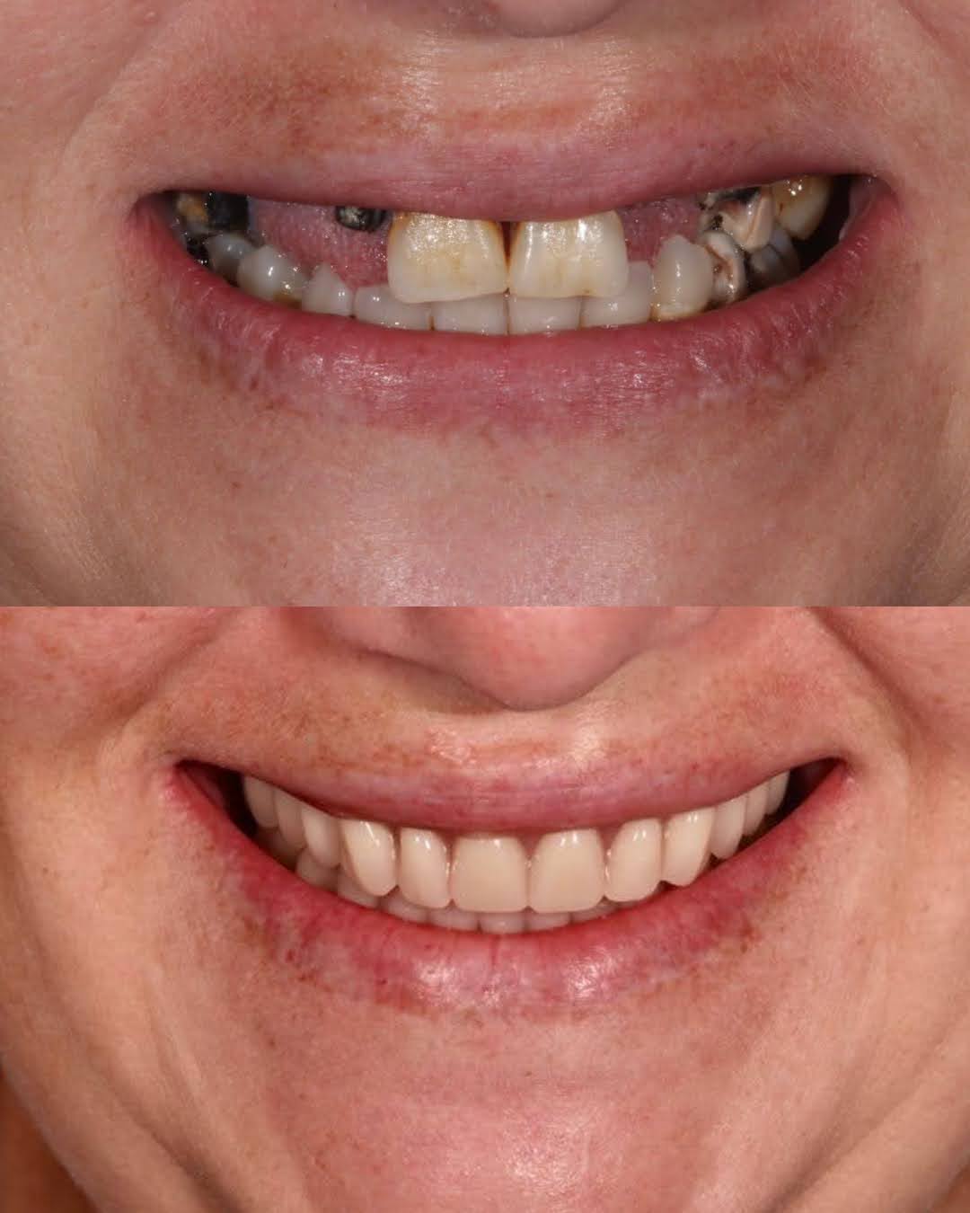 Dental implants before and after 2