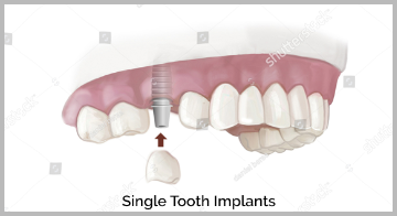 Single Dental Implants